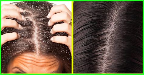 dandruff traduction|is dandruff serious.